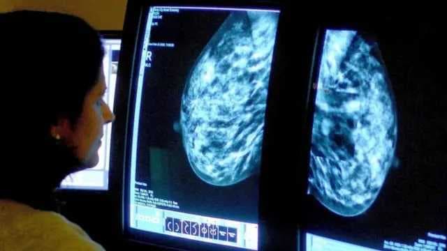 الصحة: الإصابات بسرطان الثدي في العراق ضمن المعدل العالمي