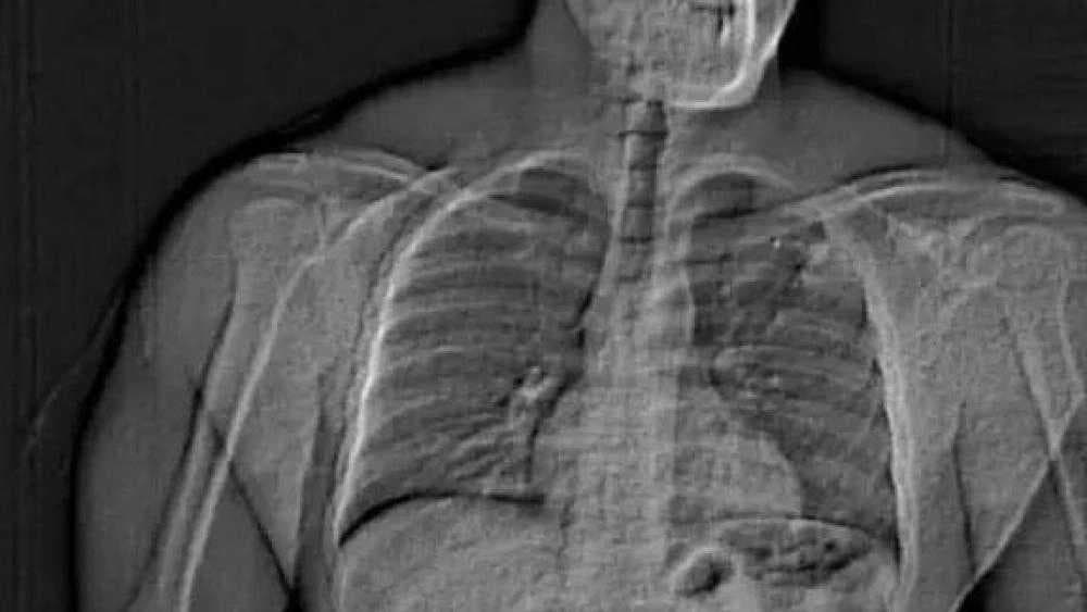 لص بـ"معدة من ألماس".. سرق مجوهرات بمليون دولار وابتلعها