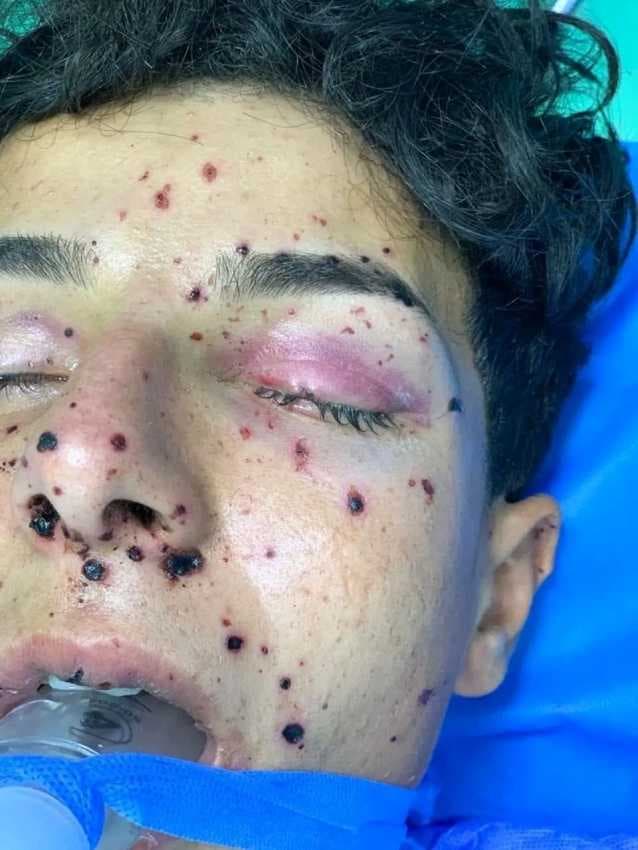 فريق طبي في مستشفى الزبير ينجح بإنقاذ بصر شاب بعد إصابته بانفجار بطارية سيارة